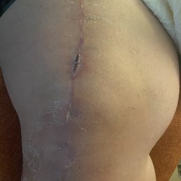 One month out and the scar is healing great. Ignore the dry skin, he needs to lotion up One month out and the scar is healing great. Ignore the dry skin, he needs to lotion up
