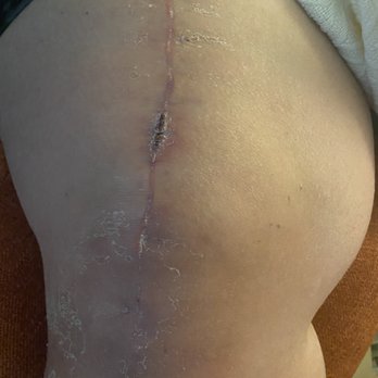 Steven T Kelley, MD - One month out and the scar is healing great. Ignore the dry skin, he needs to lotion up - Sports Medicine Near Me - Temecula, California Steven T Kelley, MD - One month out and the scar is healing great. Ignore the dry skin, he needs to lotion up - Sports Medicine Near Me - Temecula, California