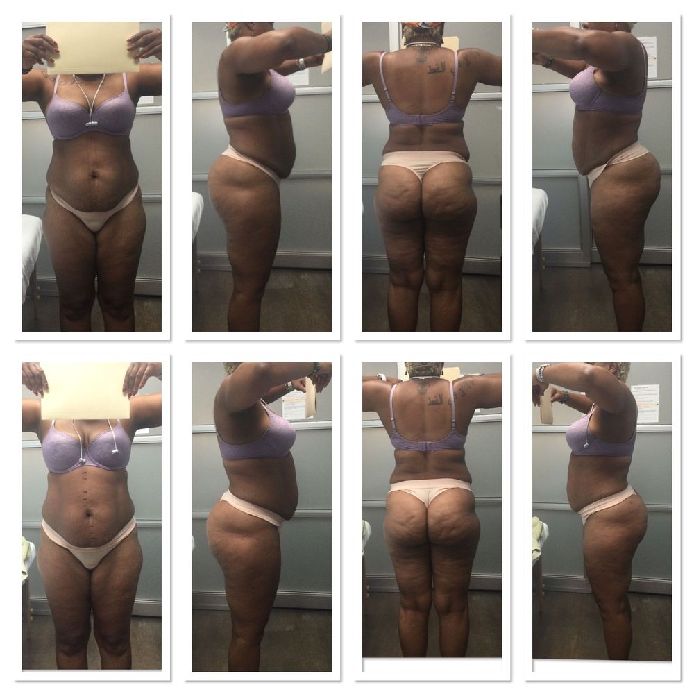 PV Laser Lipo - There is no difference unless you count the way my underwear band is positioned in the before and after. - Weight Loss Centers Near Me - Phoenix, Arizona PV Laser Lipo - There is no difference unless you count the way my underwear band is positioned in the before and after. - Weight Loss Centers Near Me - Phoenix, Arizona