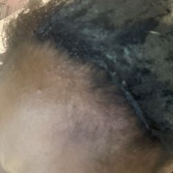 The glue was directly on my hair, causing irritation bumps to pop up. You probably can't see them that well.