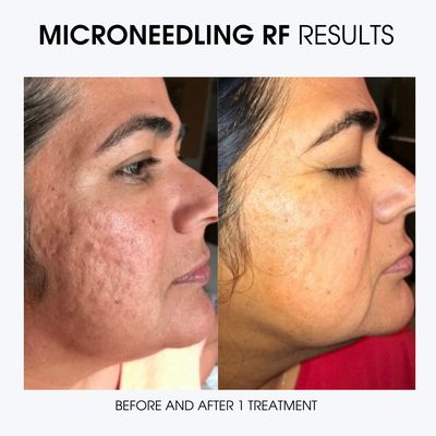 Microneedling works! - You'll see the results! Microneedling works! - You'll see the results!
