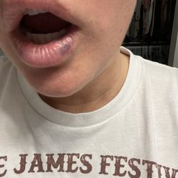 James Lowe, MD - Normal bruising