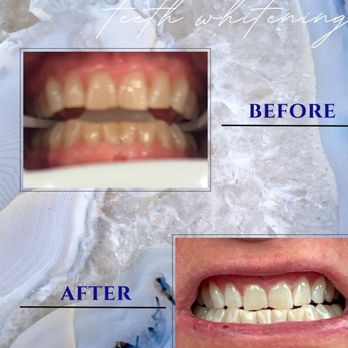 SkyeBright Smile - Before/After for 1 40 minute treatment - Teeth Whitening Near Me - Martinsville, Virginia SkyeBright Smile - Before/After for 1 40 minute treatment - Teeth Whitening Near Me - Martinsville, Virginia