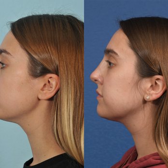 Jesse E Smith, MD, FACS - Rhinoplasty Before & After #14 - Plastic Surgeons Near Me - Fort Worth, Texas Jesse E Smith, MD, FACS - Rhinoplasty Before & After #14 - Plastic Surgeons Near Me - Fort Worth, Texas
