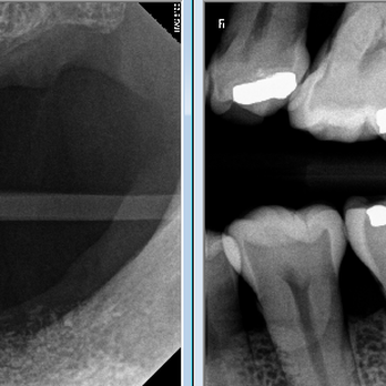 Pacific Manor Dental - Restore your implants here with confidence - General Dentistry Near Me - Pacifica, California