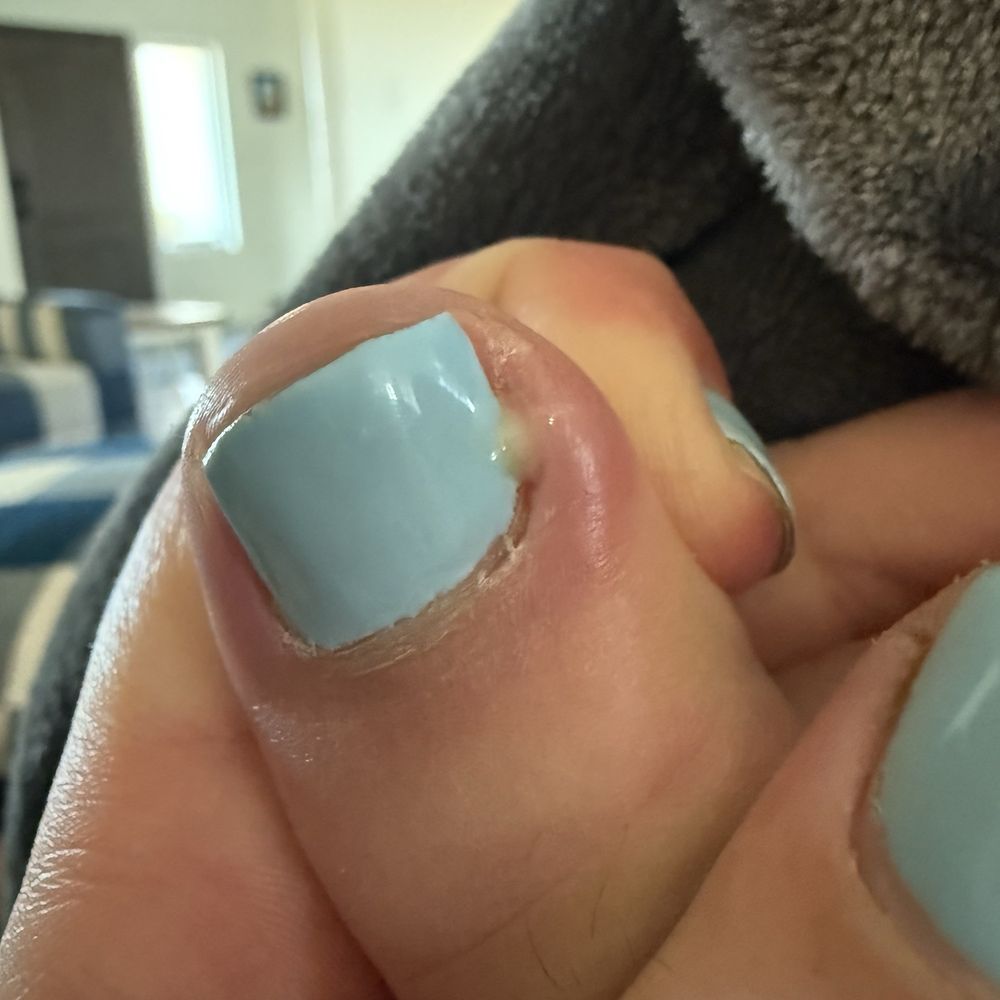 Ucare Nails Bar - Infected toe - Nail Salons Near Me - Escondido, California