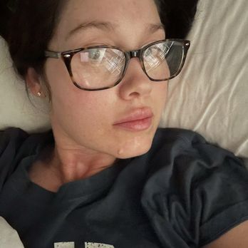 NAKEDMD - Rancho Cucamonga - Wide view of overfilled top lip ‍ - Medical Spas Near Me - Rancho Cucamonga, California