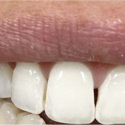 Gold Coast Dental - Significantly larger gap...