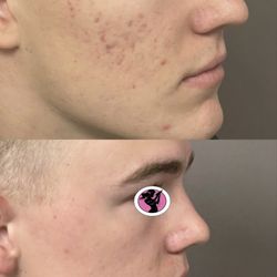 Lasergirl Skincare and Medspa - Acne solutions