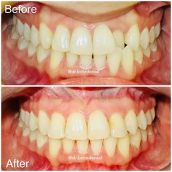 Brite Kids Dental - One tooth can completely change your smile using braces!!