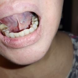 The Dentists at Creekside - Puncture under tongue