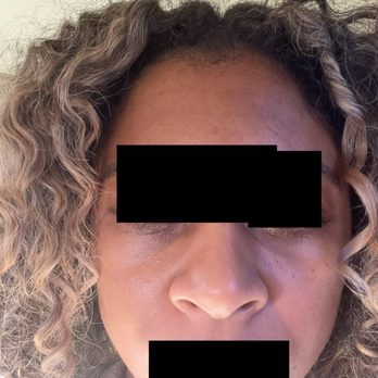 Epione - My face after receiving dark circle treatment at Epione - Skin Care Near Me - Beverly Hills, California Epione - My face after receiving dark circle treatment at Epione - Skin Care Near Me - Beverly Hills, California