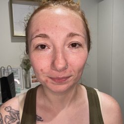 Native Beauty Medical Esthetics - Before