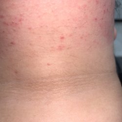 Bliss Brow Bar - Cuts, scaring, irritation, and hair that she claimed as ingrowns when those hairs weren't ingrowns.