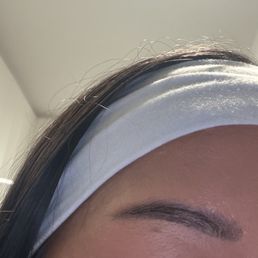 After mole removal (1 session) After mole removal (1 session)