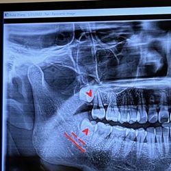 Atlanta Oral & Facial Surgery - I never knew I had - two - impacted wisdom teeth