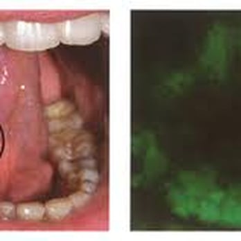 Vijeyta Bhatia, DDS - Oral cancer detection and screening
Visit www.OralCancerFoundation.org for more information on oral cancer - General Dentistry Near Me - Bloomington, Illinois Vijeyta Bhatia, DDS - Oral cancer detection and screening
Visit www.OralCancerFoundation.org for more information on oral cancer - General Dentistry Near Me - Bloomington, Illinois