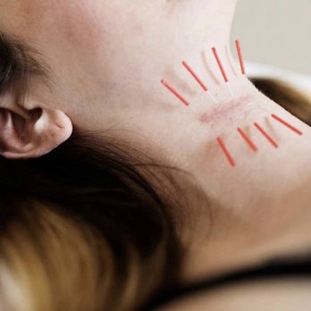 Monarch Acupuncture - A great technique to reduce the size and appearance of scars. - Acupuncture Near Me - Glen Head, New York Monarch Acupuncture - A great technique to reduce the size and appearance of scars. - Acupuncture Near Me - Glen Head, New York