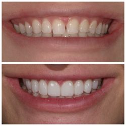Scottsdale Dental Bottega - No prep veneers