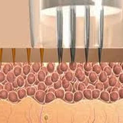The Medical Spa of Hawaii - The tiny holes that the micro-needling procedure creates aides in the natural production of collagen