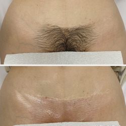 Brazilians- body waxing