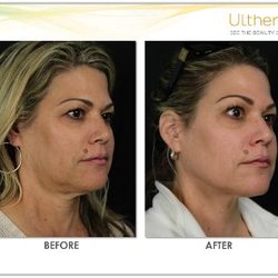 Qvita Health and Wellness - Ultherapy for face, neck, chest tightening and more!