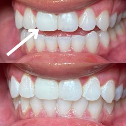 Rissa’s Glam Room - Tooth with the arrow is a crown. This client wanted to see if we can match her teeth with it to match. This was her result and she loved it.