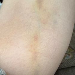 Prime IV Hydration & Wellness - Murray - My inner arm, today.