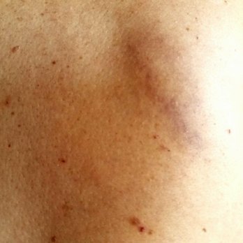 Descanso Garden Spa - Bruises after wrong massage was given - Day Spas Near Me - Tujunga, California