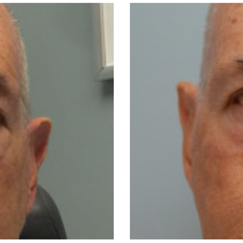 In Focus Ophthalmic Plastic Surgery - Before and After Eyelid Surgery - Plastic Surgeons Near Me - Murrieta, California In Focus Ophthalmic Plastic Surgery - Before and After Eyelid Surgery - Plastic Surgeons Near Me - Murrieta, California