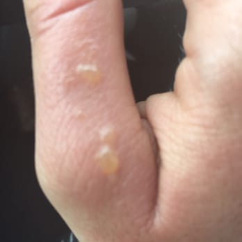 4Ever Nails - Burns from gel nails at 4ever nails - Nail Salons Near Me - Woodinville, Washington