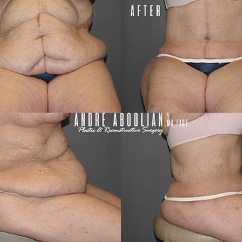 Andre Aboolian - Body Lift - Cosmetic Surgeons Near Me - Beverly Hills, California Andre Aboolian - Body Lift - Cosmetic Surgeons Near Me - Beverly Hills, California