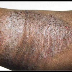 Min Wu - Psoriasis not just damaged his skin but also stiffed his joint.