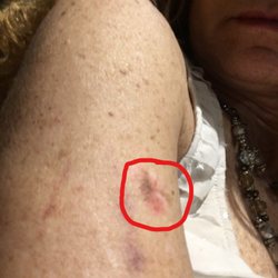 George Hsieh, MD - Advanced Dermatology & Skin Surgery - My lesion before surgery, that looks "just fine" to the doctor. It had grown to about the size of a quarter.