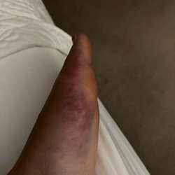Pacific Northwest Motorcycle Safety - Injury from the beginner motorcycle class