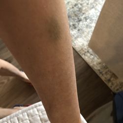 Modern Acupuncture - Black and blue on my arm 5 days after acupuncture.