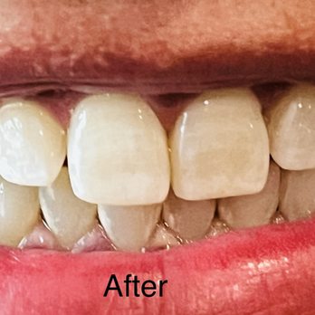Illumination Teeth Whitening - This is his after teeth whitening! - Teeth Whitening Near Me - Diamond Bar , California Illumination Teeth Whitening - This is his after teeth whitening! - Teeth Whitening Near Me - Diamond Bar , California