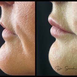 Cosmetic And Laser Dental Spa Of Richmond - LipLase Before and After
