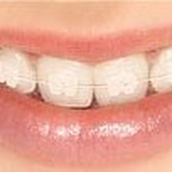 Cory J Costanzo, DDS - We offer cosmetic braces for the image conscious.