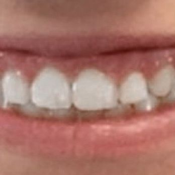 SmilePerfect Orthodontists - Final Result at age 11. - Orthodontists Near Me - Cedar Hills, Utah