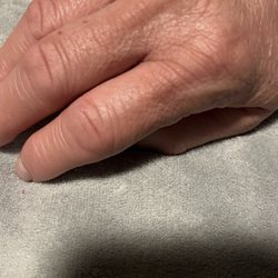Walmart Supercenter - Swollen hands