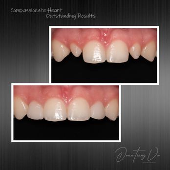 Vo Dentistry - Peg lateral restorations - General Dentistry Near Me - Lawrenceville, Georgia Vo Dentistry - Peg lateral restorations - General Dentistry Near Me - Lawrenceville, Georgia