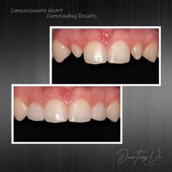 Vo Dentistry - Peg lateral restorations