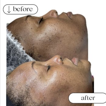 Mystika Beauty - Chemical Peel - Medical Spas Near Me - Sunrise, Florida Mystika Beauty - Chemical Peel - Medical Spas Near Me - Sunrise, Florida
