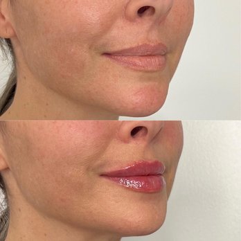 SkinSpirit - UES - Lip filler - Skin Care Near Me - New York, New York SkinSpirit - UES - Lip filler - Skin Care Near Me - New York, New York