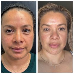 DermFx - VI Chemical Peel