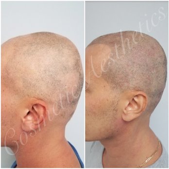 Hair Follicle Replication Tattoo To Give The Appearance Of A