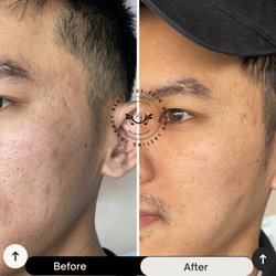 Bio-Micro needling
