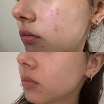 Veronika’s Aesthetics - Before and After - Skin Care Near Me - Pound Ridge, New York Veronika’s Aesthetics - Before and After - Skin Care Near Me - Pound Ridge, New York