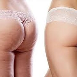 Body Sculpt-her - Cavitation results